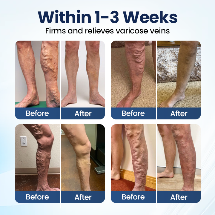 Cheeroll@  Deep Vein Repair Microneedle Patch