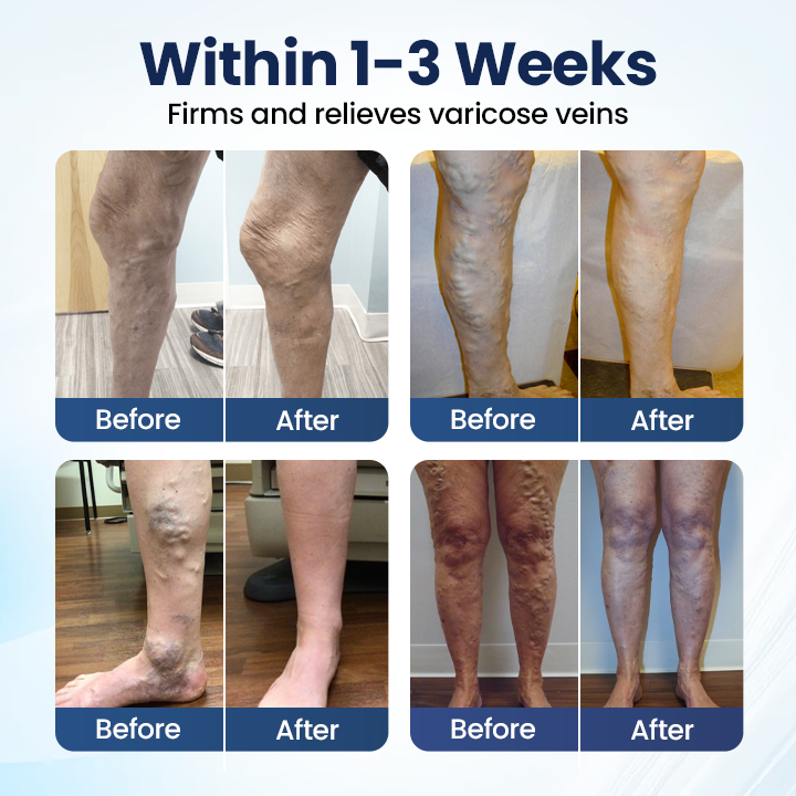 Cheeroll@  Deep Vein Repair Microneedle Patch