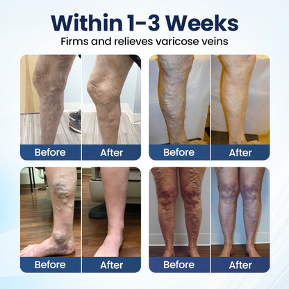 Cheeroll@  Deep Vein Repair Microneedle Patch